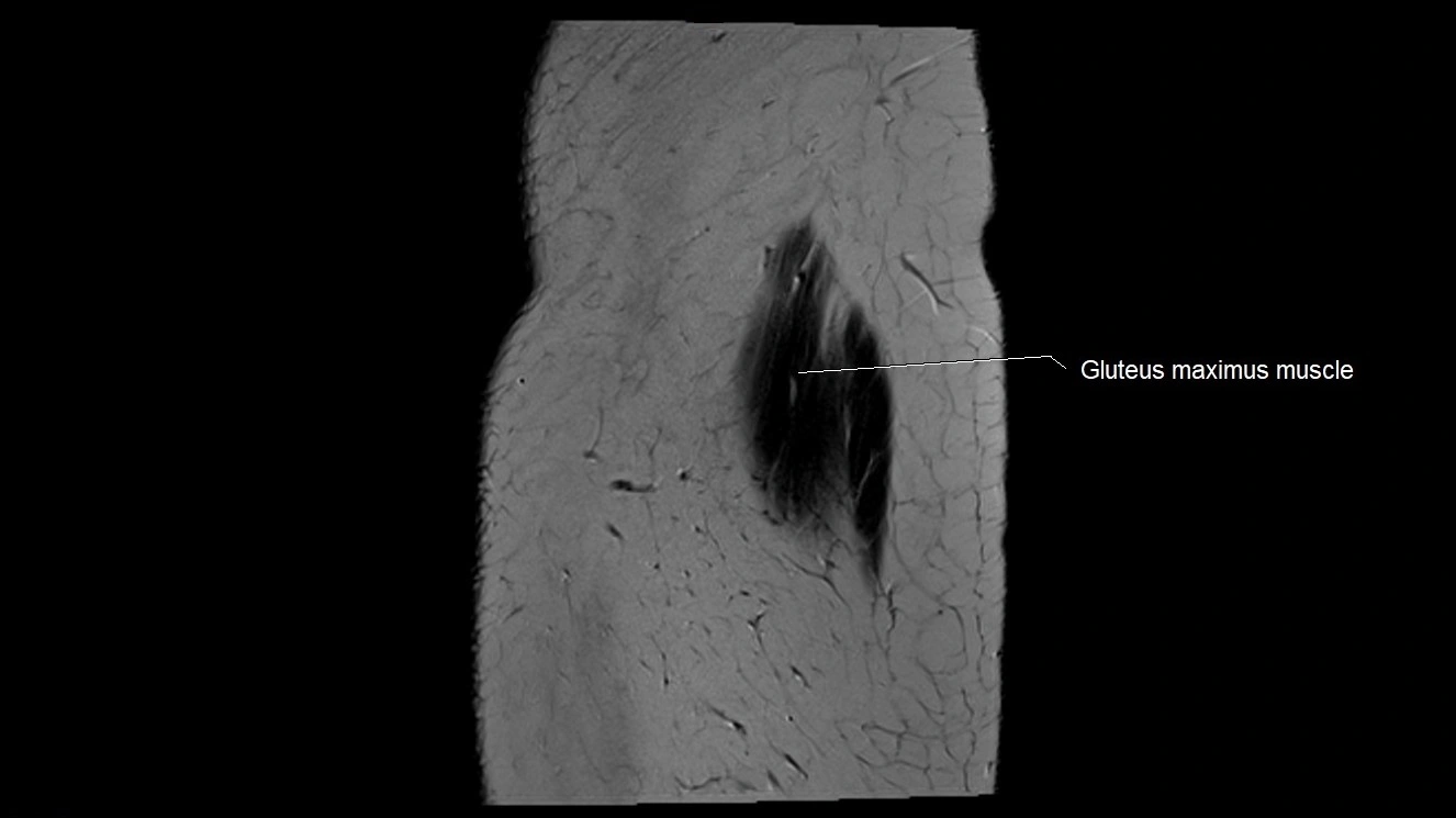 Hip sagittal cross sectional anatomy image 1.webp
